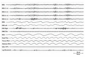 Tracé de polysomnographie montrant plusieurs signaux physiologiques alignés, dont EEG, EOG, EMG, ECG, flux nasal, efforts thoracique et abdominal, saturation en oxygène et mouvements des jambes.