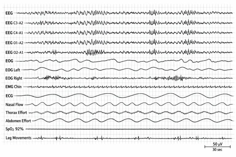 Tracé de polysomnographie montrant plusieurs signaux physiologiques alignés, dont EEG, EOG, EMG, ECG, flux nasal, efforts thoracique et abdominal, saturation en oxygène et mouvements des jambes.